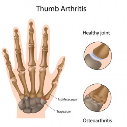 CMCJ Arthritis of the Thumb