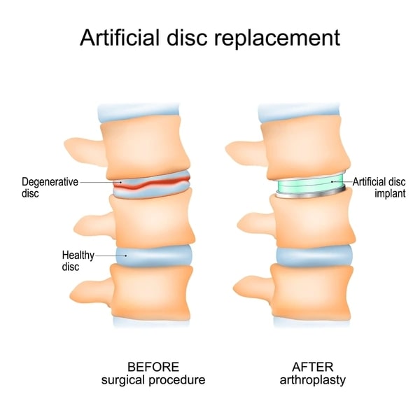 Artificial Disc Replacement