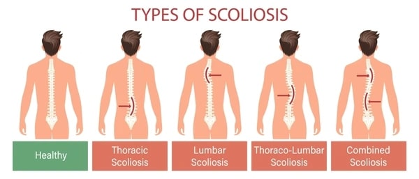 Thoracolumbar Scoliosis