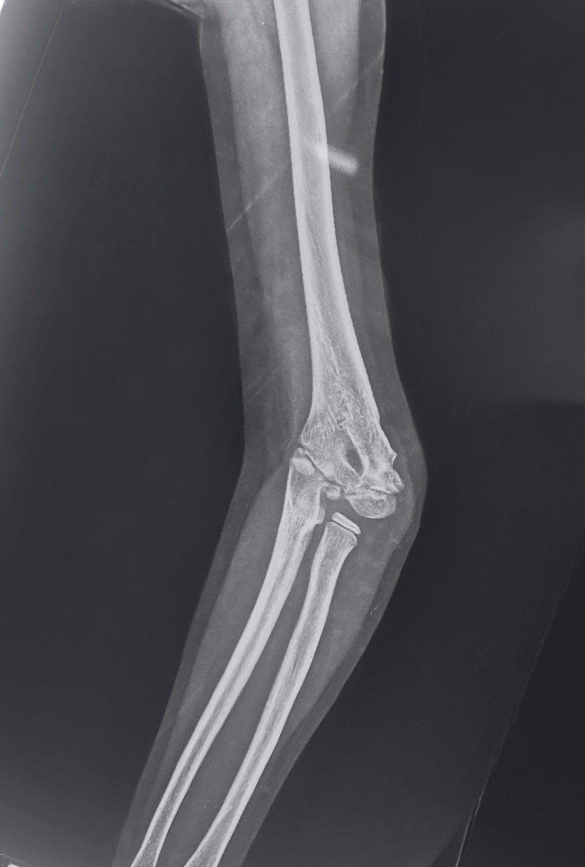 Cubitus varus deformity X-Ray