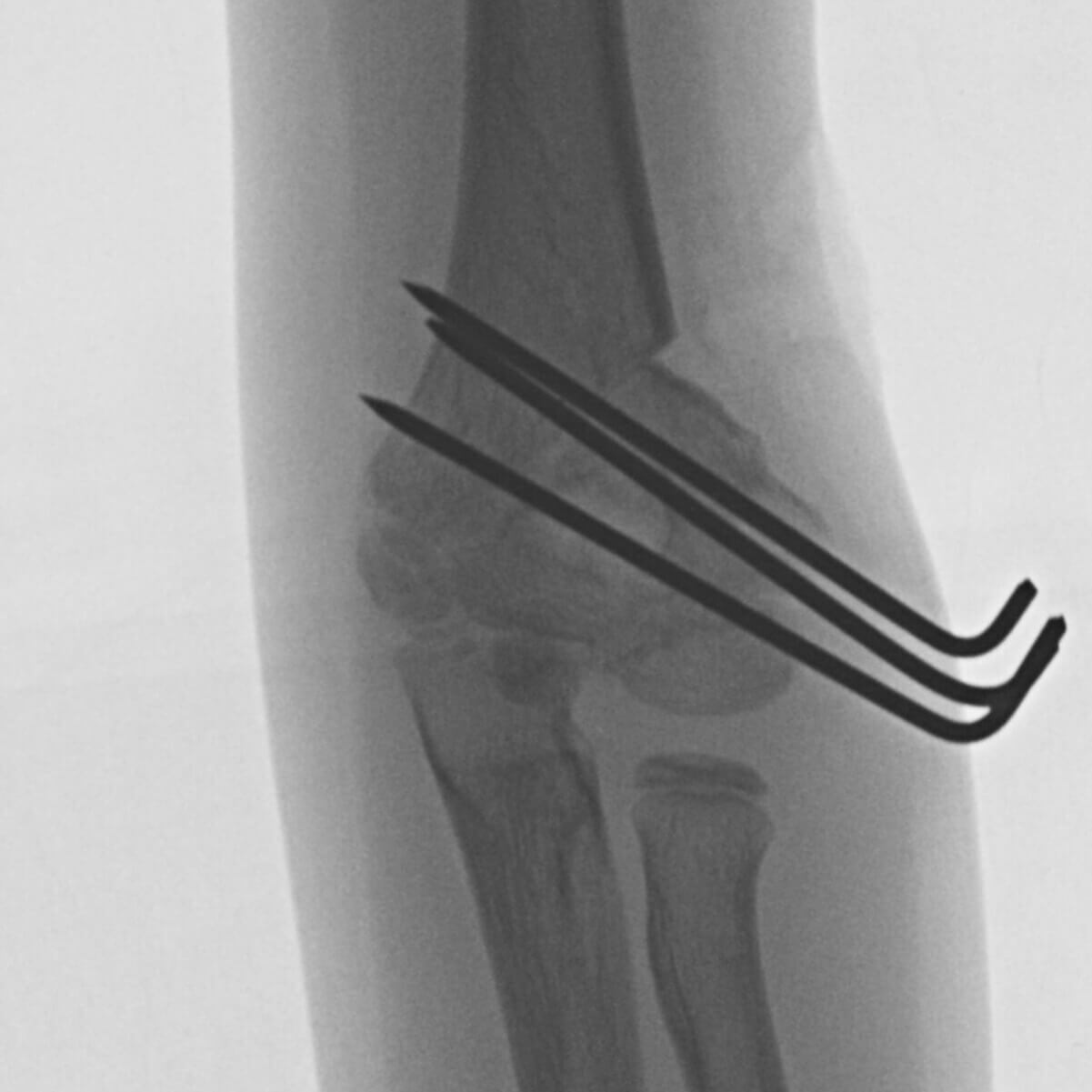 Intra-operative C-arm images-2