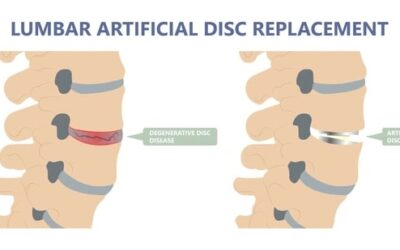 What is Lumbar Disc Replacement Surgery?