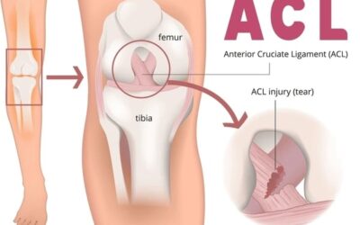 Arthroscopic Surgery for ACL Injuries