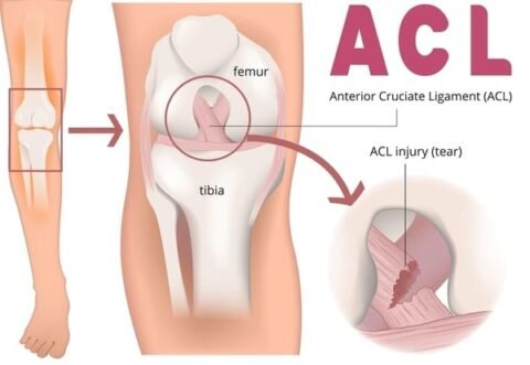Arthroscopic Surgery for ACL Injuries - PinnacleOrthoCentre