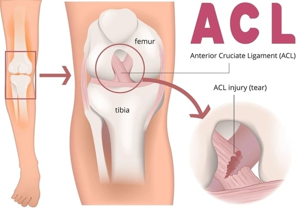 Arthroscopic Surgery for ACL Injuries