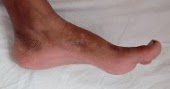 Figure 1- Normal Arch of Foot