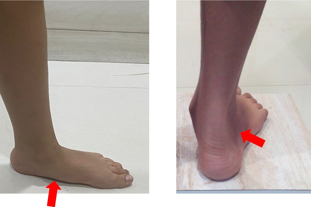 Figure 2- Flatfoot