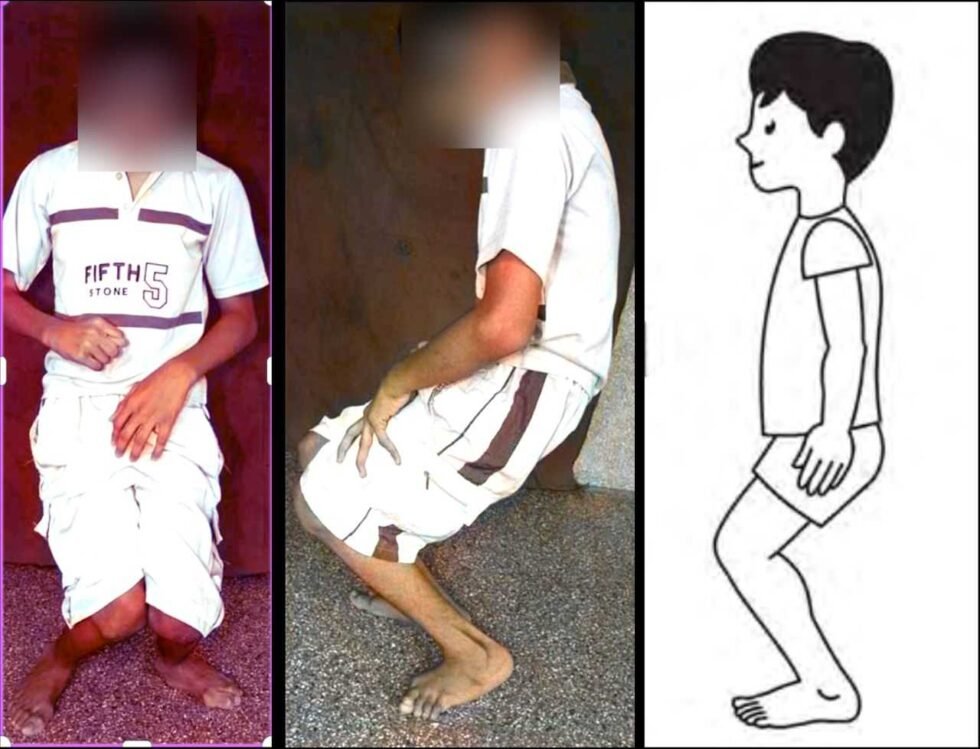 Crouch Gait in Cerebral Palsy - PinnacleOrthoCentre