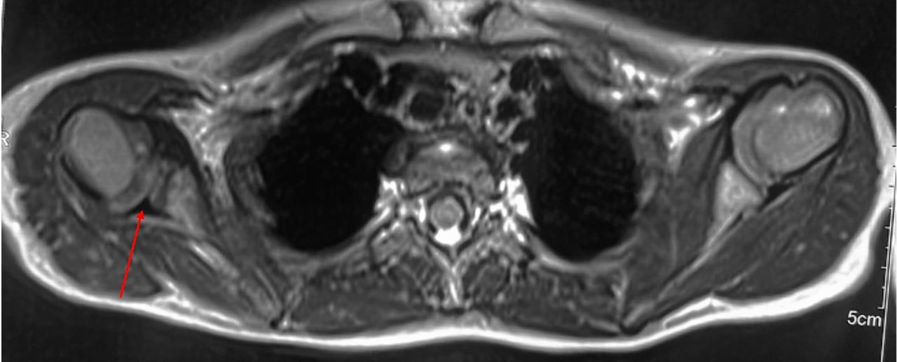 MRI is the imaging modality of choice to diagnose shoulder joint pathology in BPBP