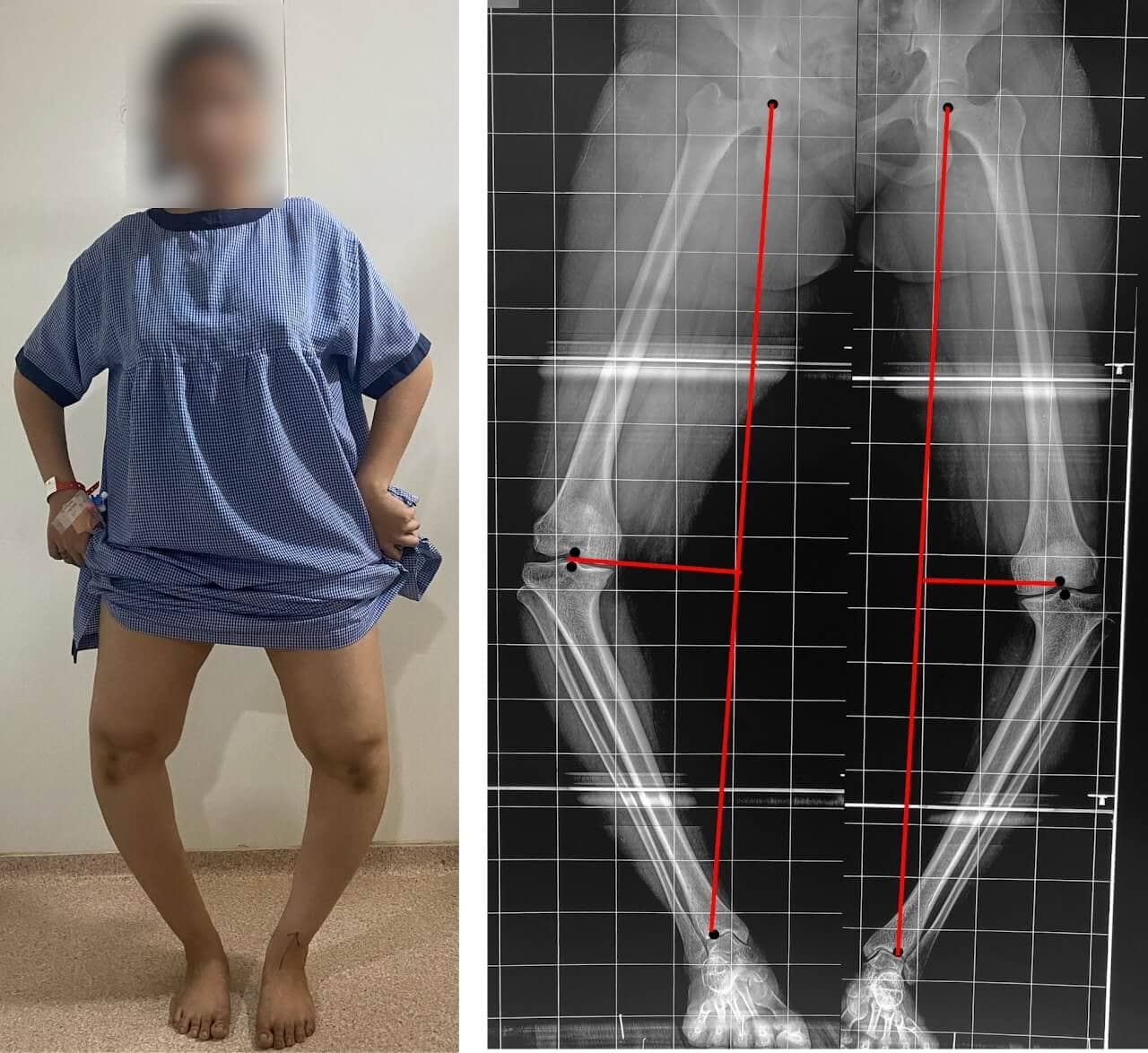 Pre-operative X-ray of 20 years old female child