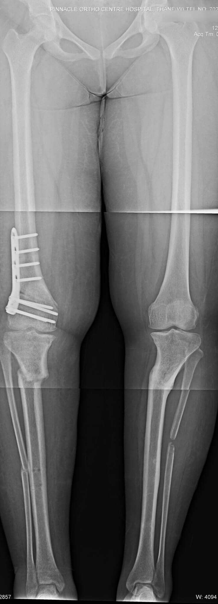 X-ray shows correction of deformity