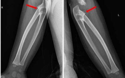 What is Congenital Radius Ulna Synostosis?