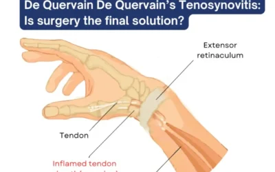 De Quervain’s Tenosynovitis: Symptoms, Causes and Treatments