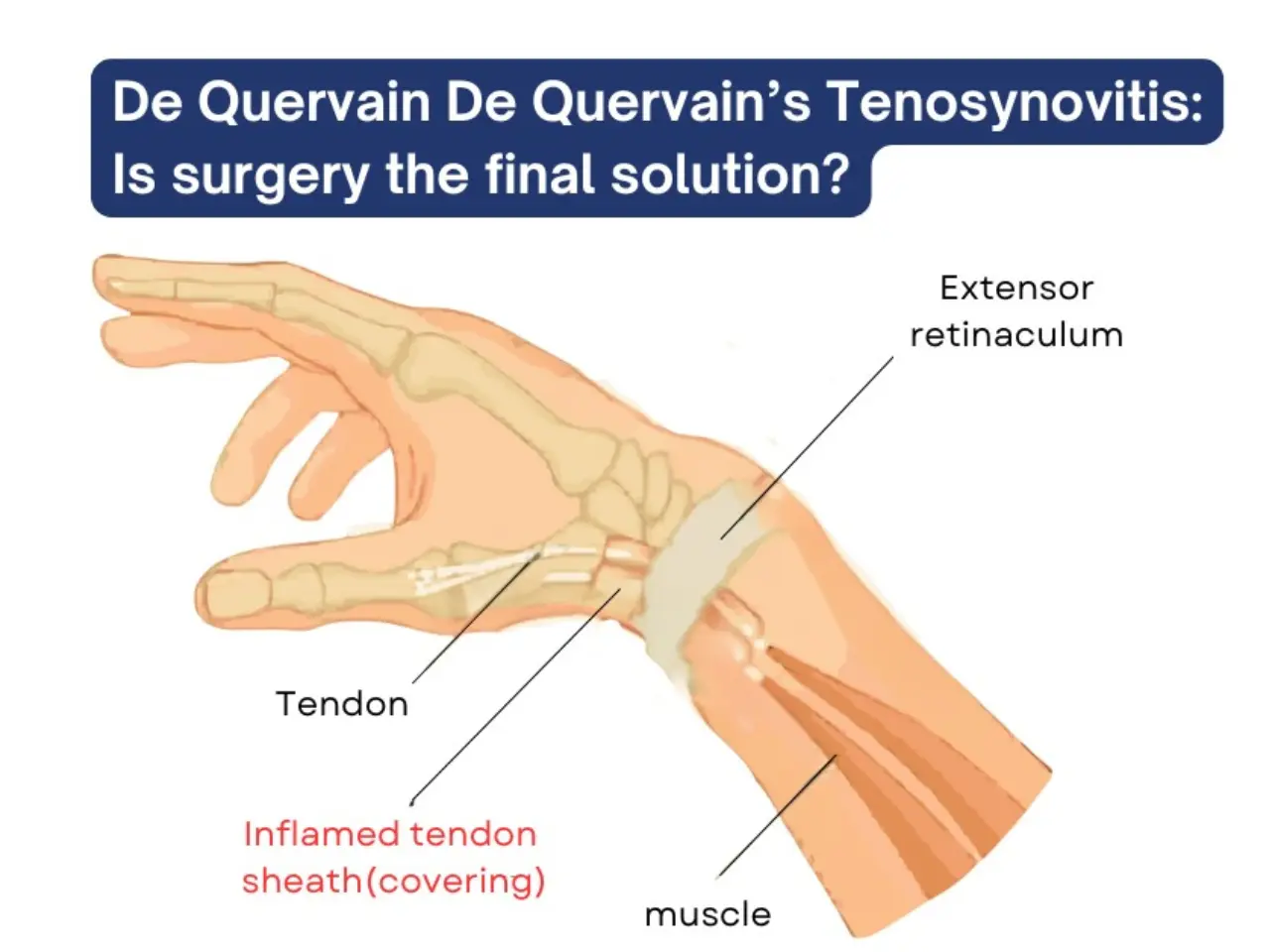 De Quervain’s Tenosynovitis