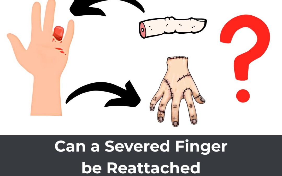 Can Severed Finger or Hand Be Reattached?