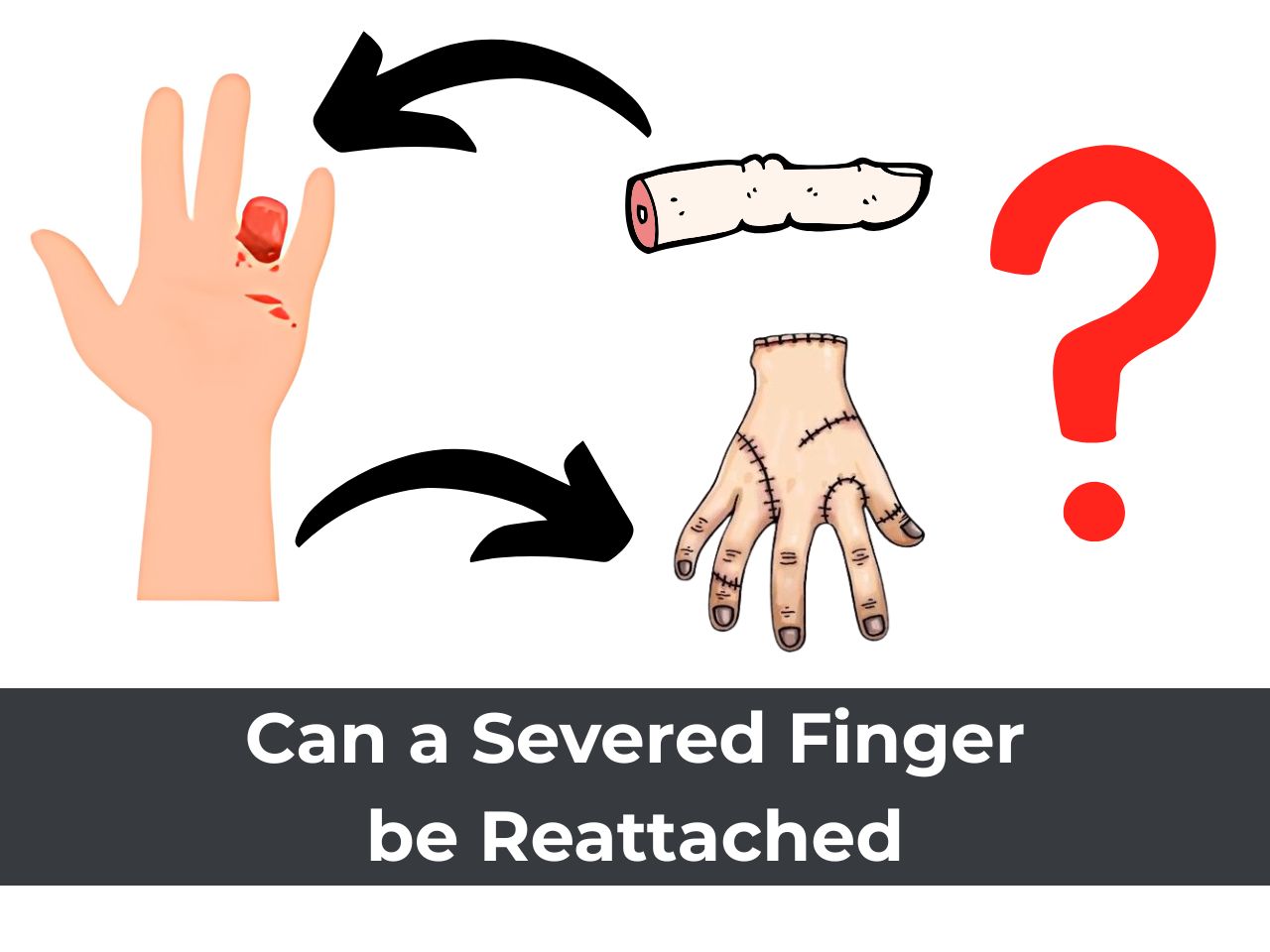 Can Severed Finger or Hand Be Reattached