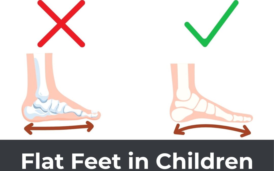 Flat Feet in Children: Myths and Facts