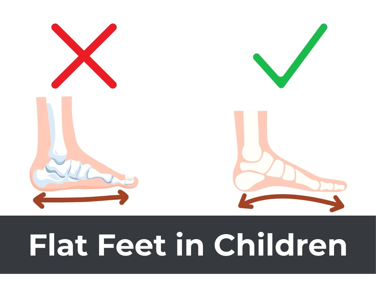 Flatfeet in child