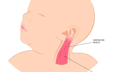 Torticollis in Babies: Causes, Symptoms and Treatment