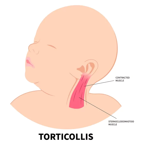 Torticollis in Babies