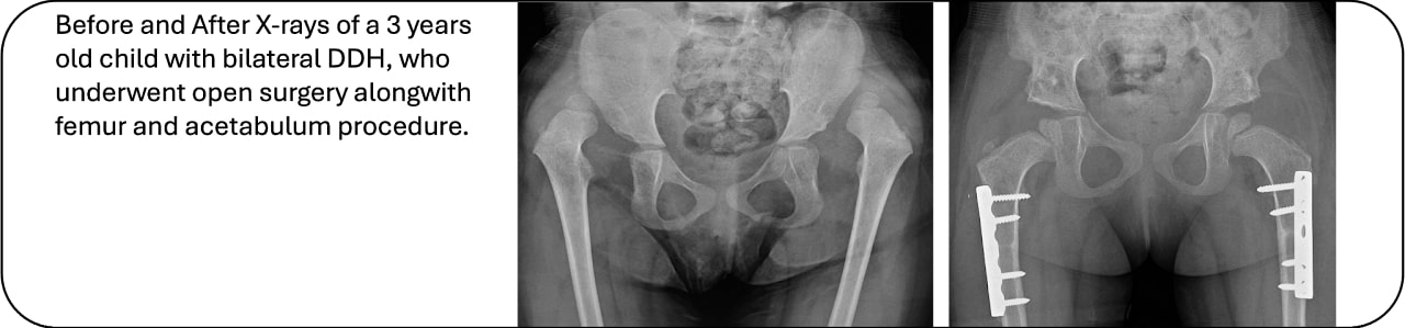 Before and After X-rays of 3 years old child with DDH