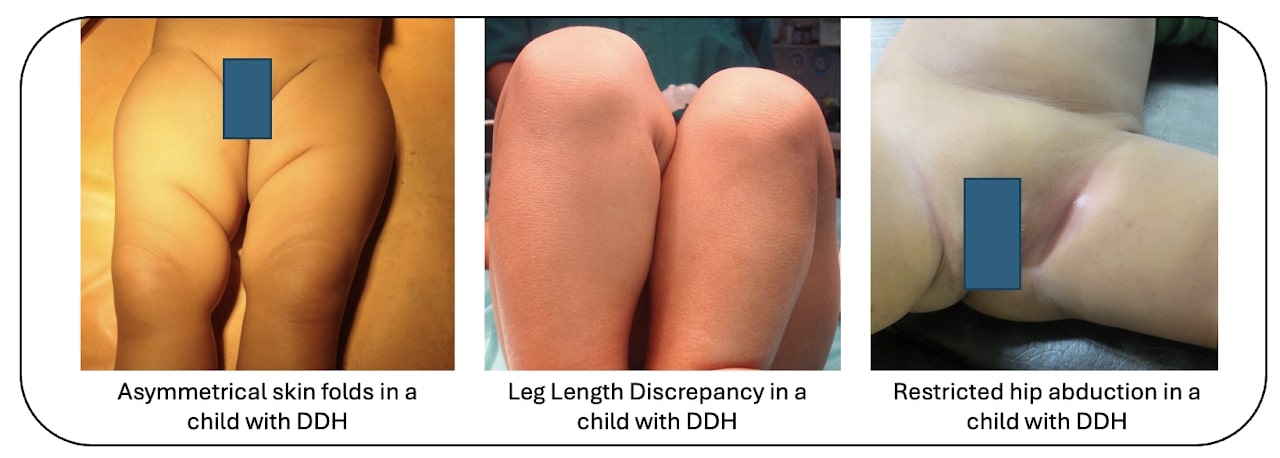 DDH with the affected leg being shorter than the normal leg