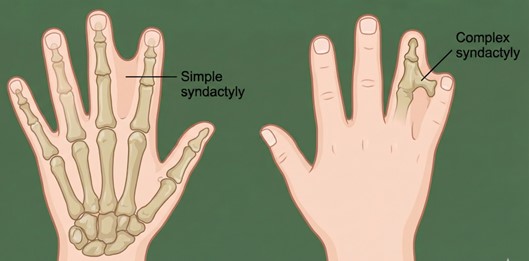 Simple vs. Complex Syndactyly