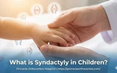 What is Syndactyly in Children?