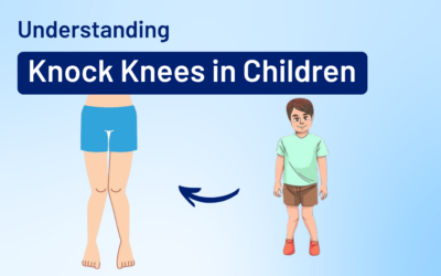 Understanding Knock Knees in Children