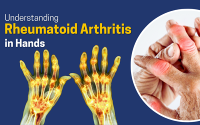 Understanding Rheumatoid Arthritis in Hands
