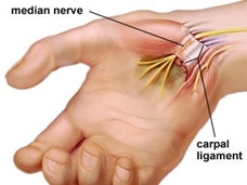 Carpal Tunnel Syndrome