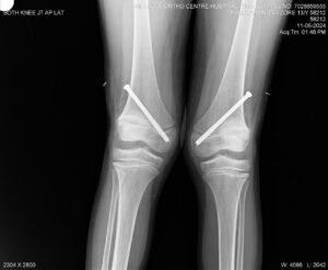 Knock Knees