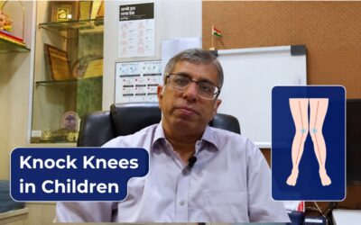 Knock Knees Holding Your Child Back? Here’s How We Fix It Naturally