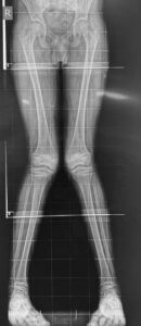 Knock Knees